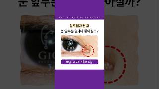 앞트임 재건 수술 복원수술 받으면 얼마나 좋아질까?? 맹꽁이 되지 않는곳 찾는다면 !? | #지오성형외과 #앞트임재건 #앞트임재건수술 #앞트임복원 #앞트임복원후기 #앞트임재건후기