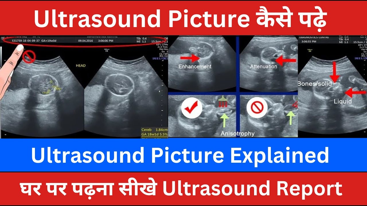 Ultrasound Picture Explained Ultrasound Report In Hindi Sonography Pictures YouTube