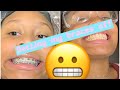 Getting Braces Removed ! *scary*