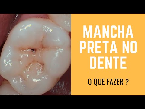 Mancha Preta no Dente - O que fazer ?!