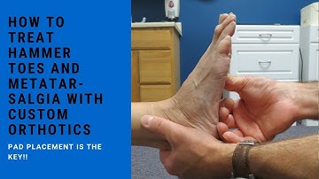 How to Treat Hammer Toes and Metatarsalgia with Custom Orthotics