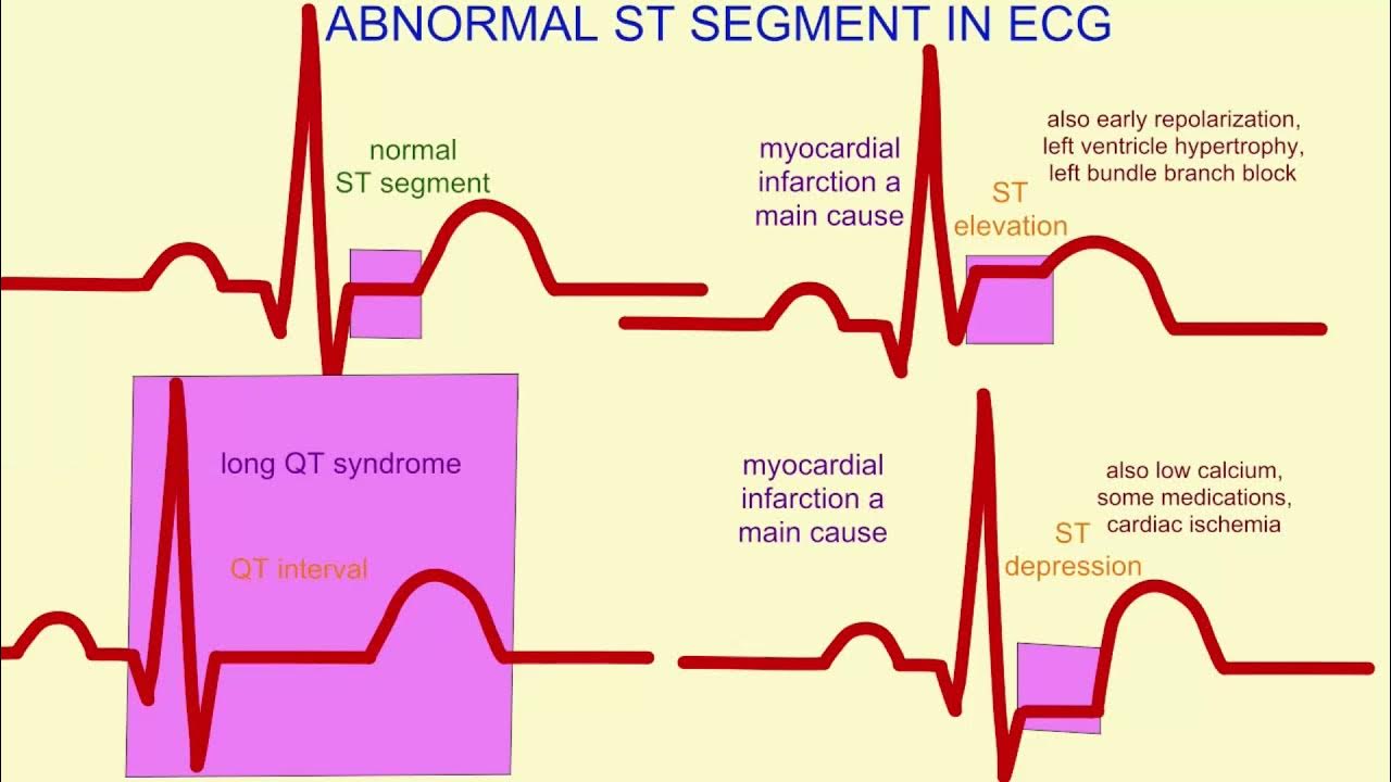 Ecg anormal que significa