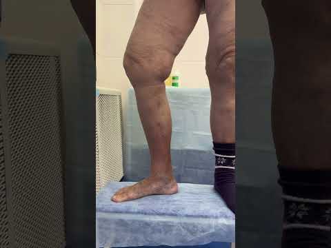 #флебологмосква #варикоз_как_избавиться #лечениеварикоза #флеболог #шортс #полезности #допосле