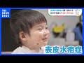 皮膚の難病の子どもたちに“おいしい栄養” 「世界一やさしいチョコレート」【SDGｓ】｜TBS NEWS DIG