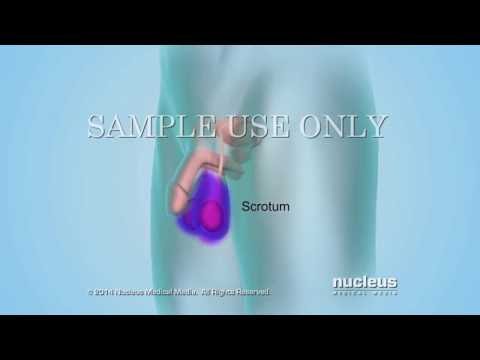 Videó: A Kutatási Trendek és A Spermiumok DNS-fragmentációs Tesztelésének Hotspotjai Nyomon Követése A Férfiak Meddőségének Kiértékelése Céljából: Egy Scientometrikus Elemzés