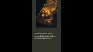 Acoustic shadowing #artifacts #ultrasound #health #ultrasoundtech