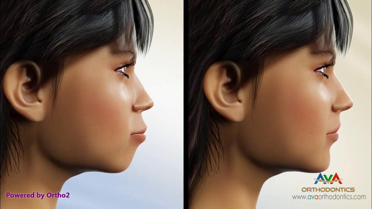 Orthodontic Treatment for Excessive Lip Support Removing 4 Premolars