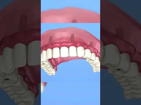 Implant dentaire +Couronne