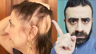 تحذير الروزماري ( اكليل الجبل ) المنتشر يسبب الصلع و تساقط الشعر - Rosemary Oil For Hair Growth