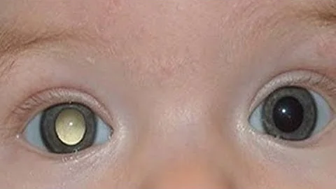 O que é uma mancha branca nos olhos?