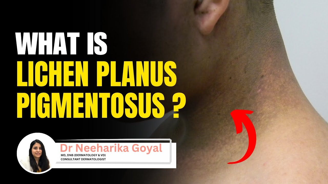 what-is-lichen-planus-pigmentosus-lichen-planus-causes-treatment