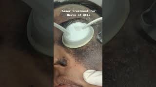 laser for pigmentation lasertreatment skincare lucknow