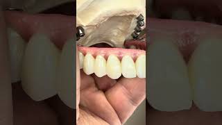 Overcoming From Huge Pontic.. Made Ceramics From Cr Co