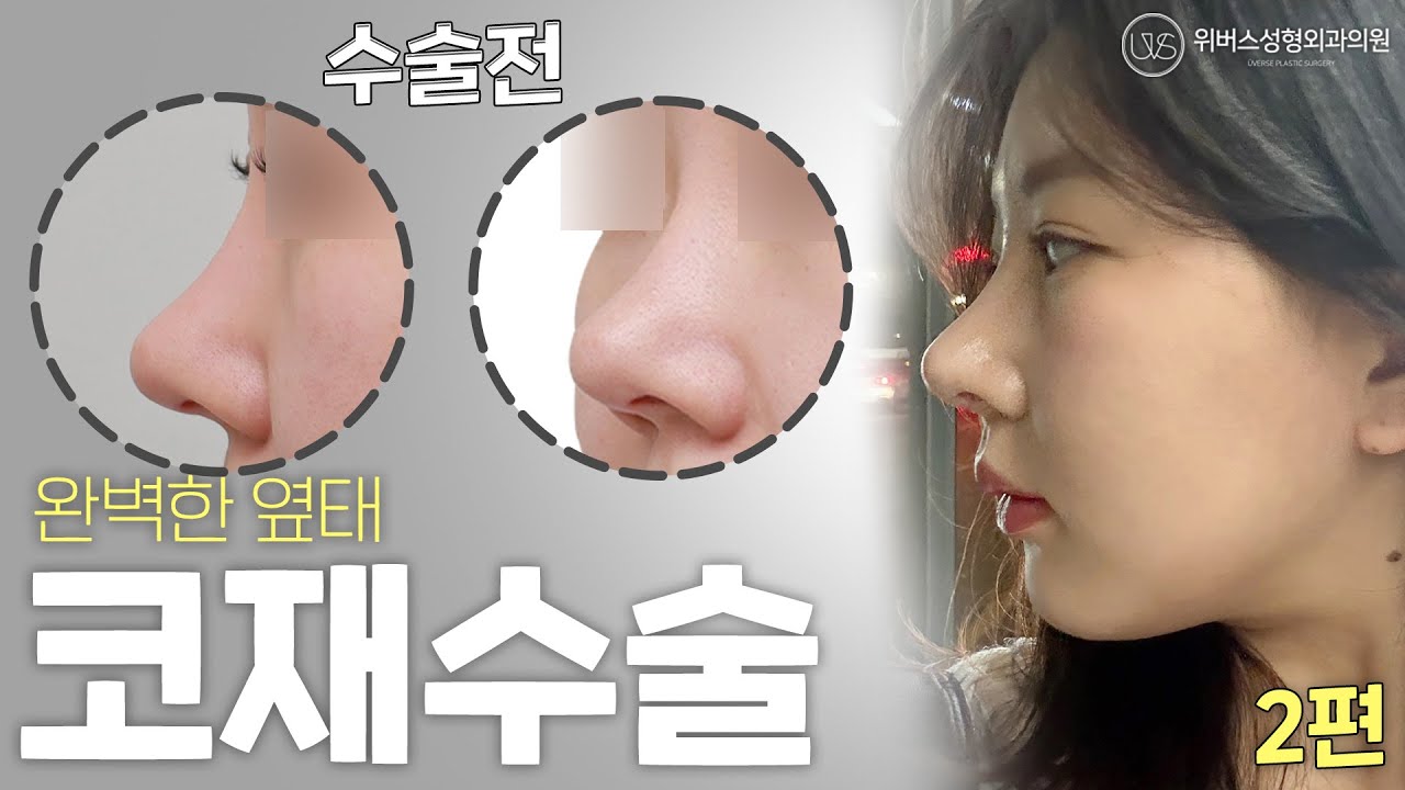 [Вэбэрс гоо сайхны мэс заслын клиник] Төгс хажуугийн төрх 💖 Хамар давтан мэс засал [2-р хэсэг]