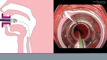 gastroduodenal FTRD® | Insertion technique
