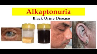 What Is Alkaptonuria? Why Does Urine Turn Black? Metabolism of Tyrosine and Phenylalanine (Part 1)