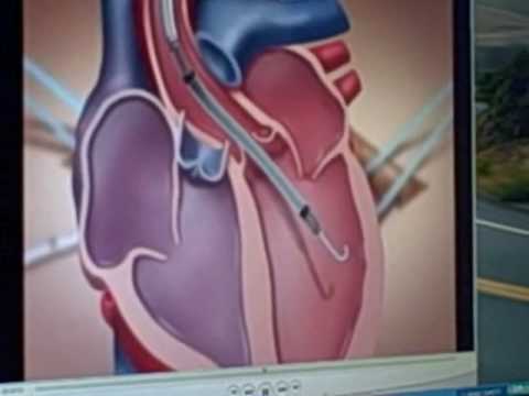 Impella 5.0 animation showing how it aids heart fa...