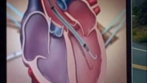 Impella 5.0 animation showing how it aids heart failure patients