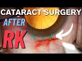 Cataract surgery approach after radial keratotomy rk  monofocal lens