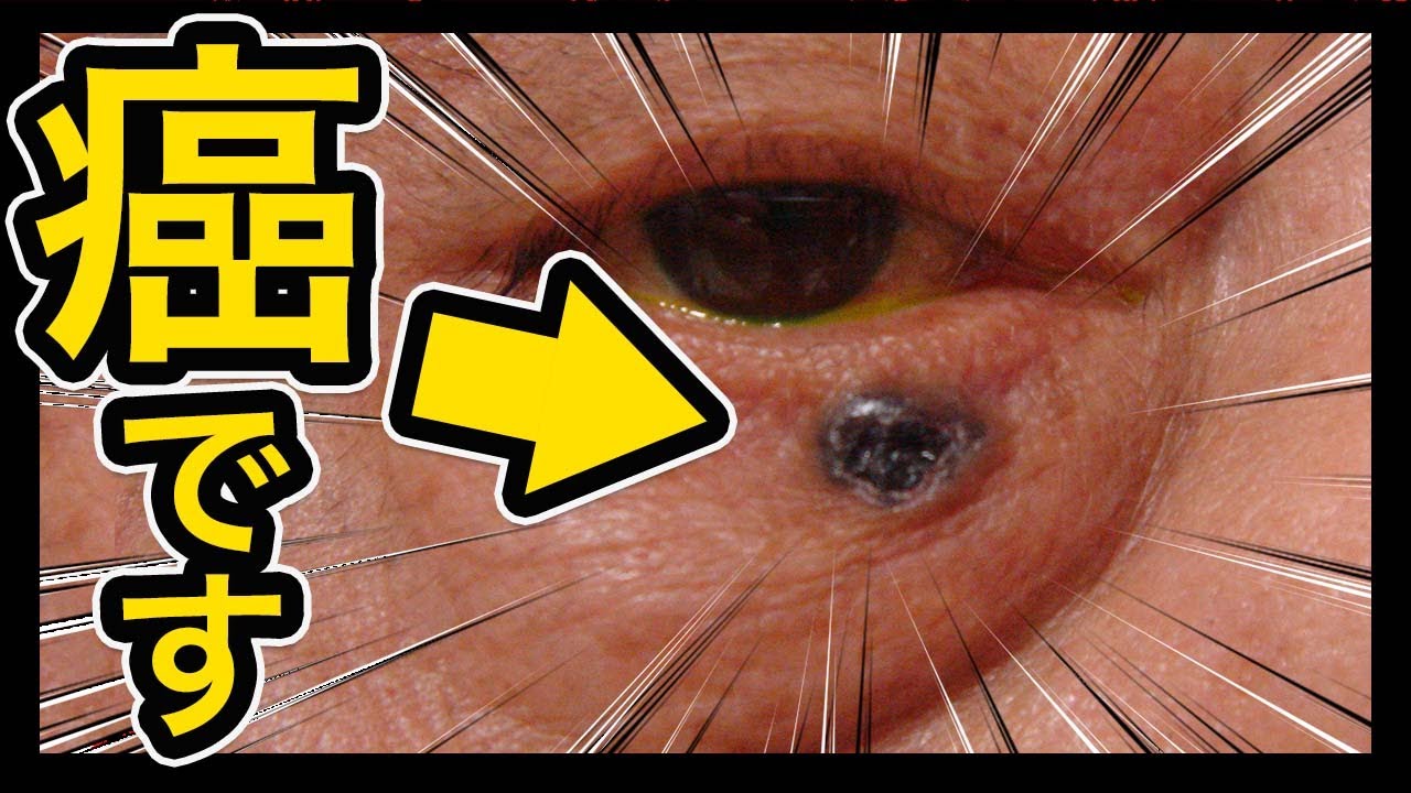 実例あり】ホクロじゃなくて癌！？とってもいいの？大きくなってきた