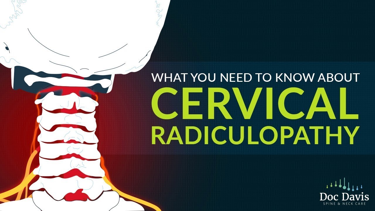 Doc Davis Discusses Cervical Radiculopathy