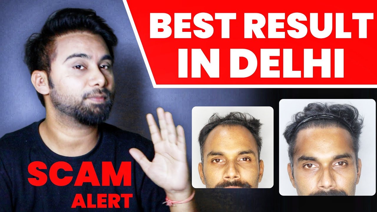 Hair Transplant Scam In India 2026 🔥🔥🔥 3 Hair Transplant Clinics 
