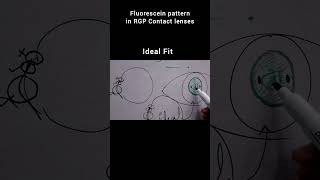 See the Ideal Fluorescein Pattern for RGP Lenses! 👁️✨ #optometry #rgp #contactlens #shorts #clinic