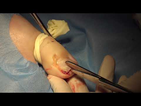 Video: Inngrodd Tanngelkirurgi: Prosedyre Og Ettervern