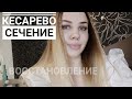 ЭКСТРЕННОЕ КЕСАРЕВО СЕЧЕНИЕ(ЭКС) | Мои роды | Восстановление