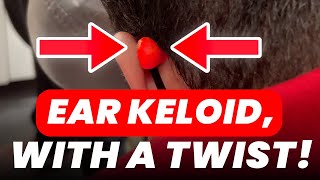Ear Keloid With A Twist