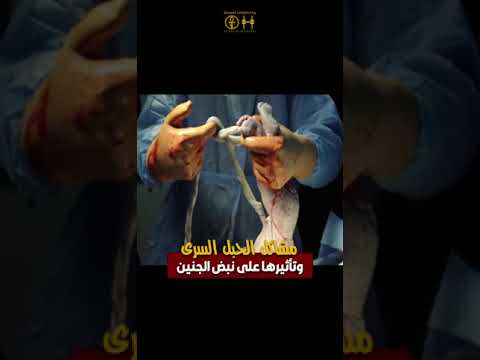 مشاكل الحبل السري وشرح مفسر من دكتور سيد الاخرس في مستشفى الأمم مصر 