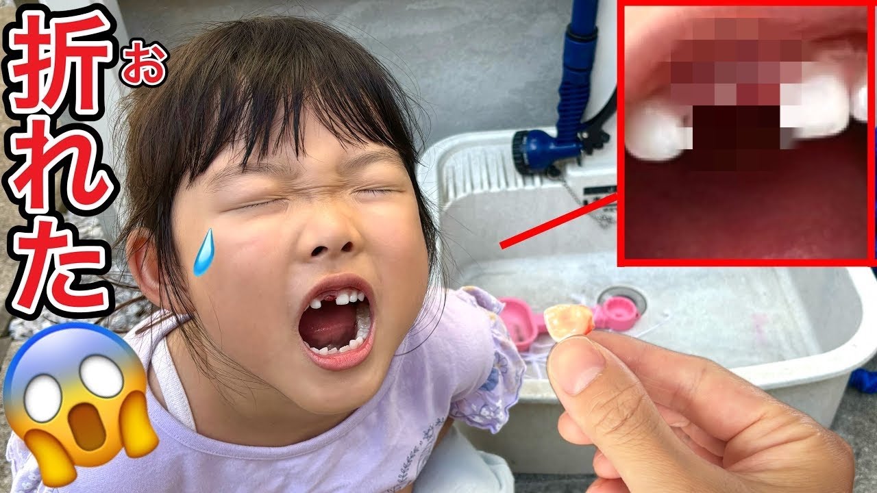 Report] Koko-chan fell, hit her face and broke a tooth - YouTube