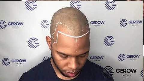 What does a First Session ScalpMicropigmentation look like?