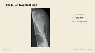 Child's Bone Broke From a Small Knock? It Could Be a Bone Cyst screenshot 4