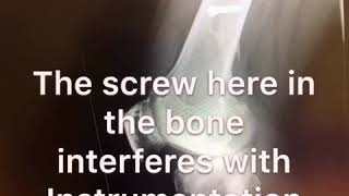 Patient Specific Knee Surgery