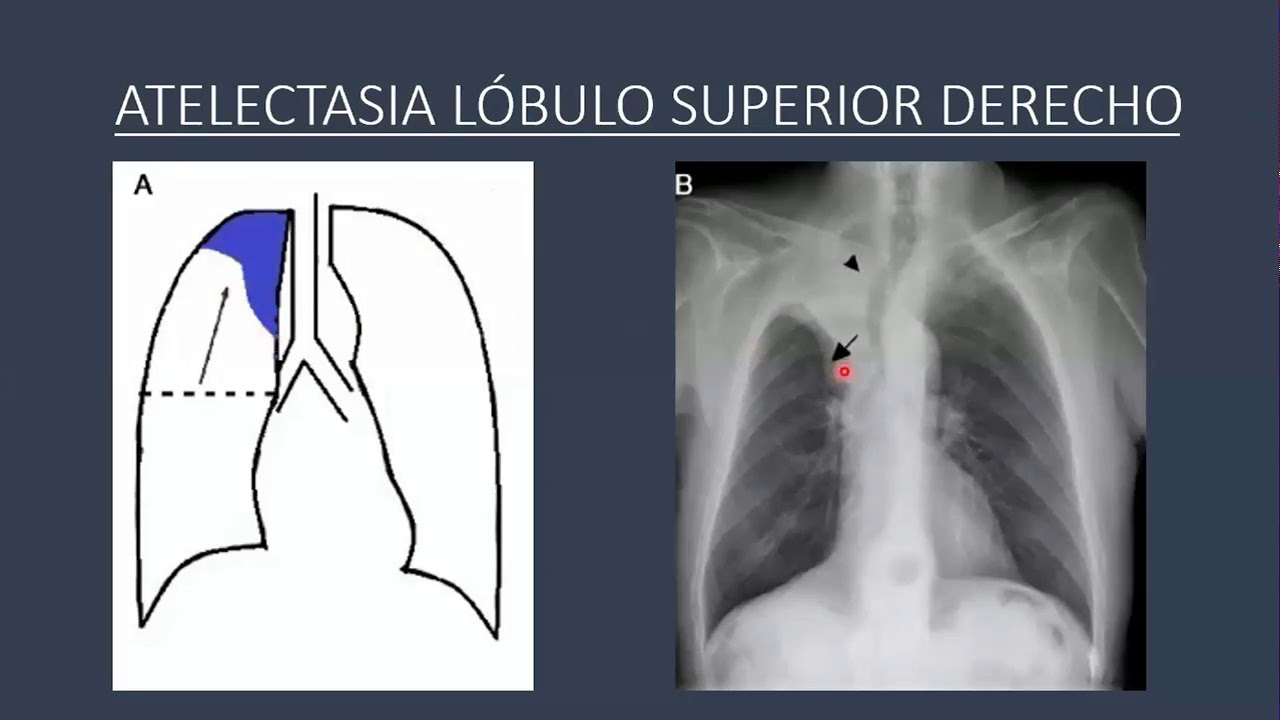 Enfermedad pulmonar obtructiva Cronica, Atelectasia y Vías Aéreas - YouTube