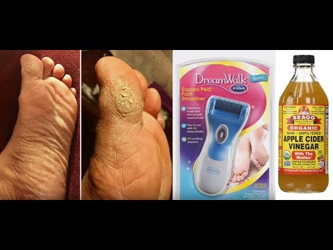 Apple Cider Vinegar - Dry Itchy Callus 