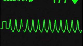 Monomorphic Ventricular Tachycardia - ECG Simulator - Arrhythmia Simulator