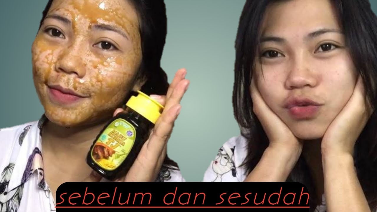 Masker Madu Tj Untuk Menghilangkan Jerawat Dan Mencerahkan Kulit 
