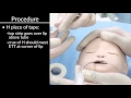 "Securing Oral and Nasal Endotracheal Tubes" by Craig Smallwood, RRT, for OPENPediatrics