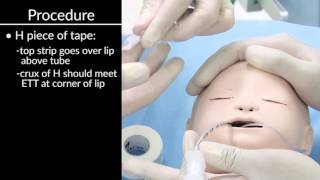 'Securing Oral and Nasal Endotracheal Tubes' by Craig Smallwood, RRT, for OPENPediatrics