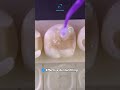 How to make a composite tooth