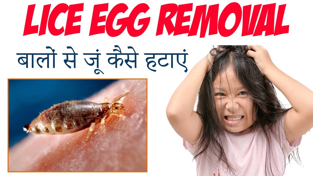 How to remove lice from hair      