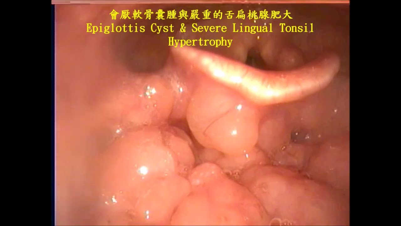 喉嚨會厭軟骨囊腫與舌扁桃腺肥大epiglottis Cyst Severe Lingual Tonsil Hypertrophy Youtube