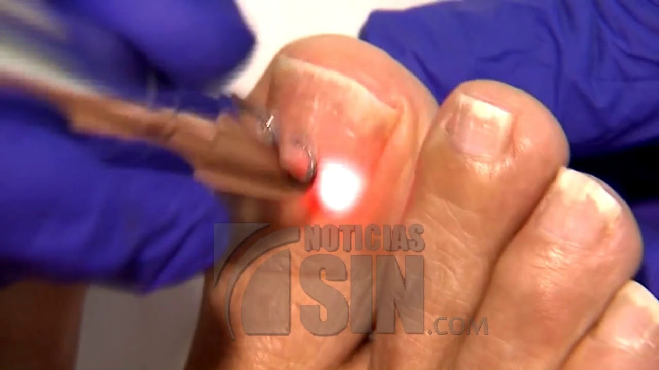 uñas estriadas y diabetes
