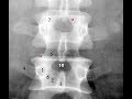 Radiological Anatomy of the Lumbar Spine: X-ray, MRI & CT Covered