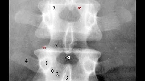 Radiological Anatomy of the Lumbar Spine: X-ray, MRI & CT Covered