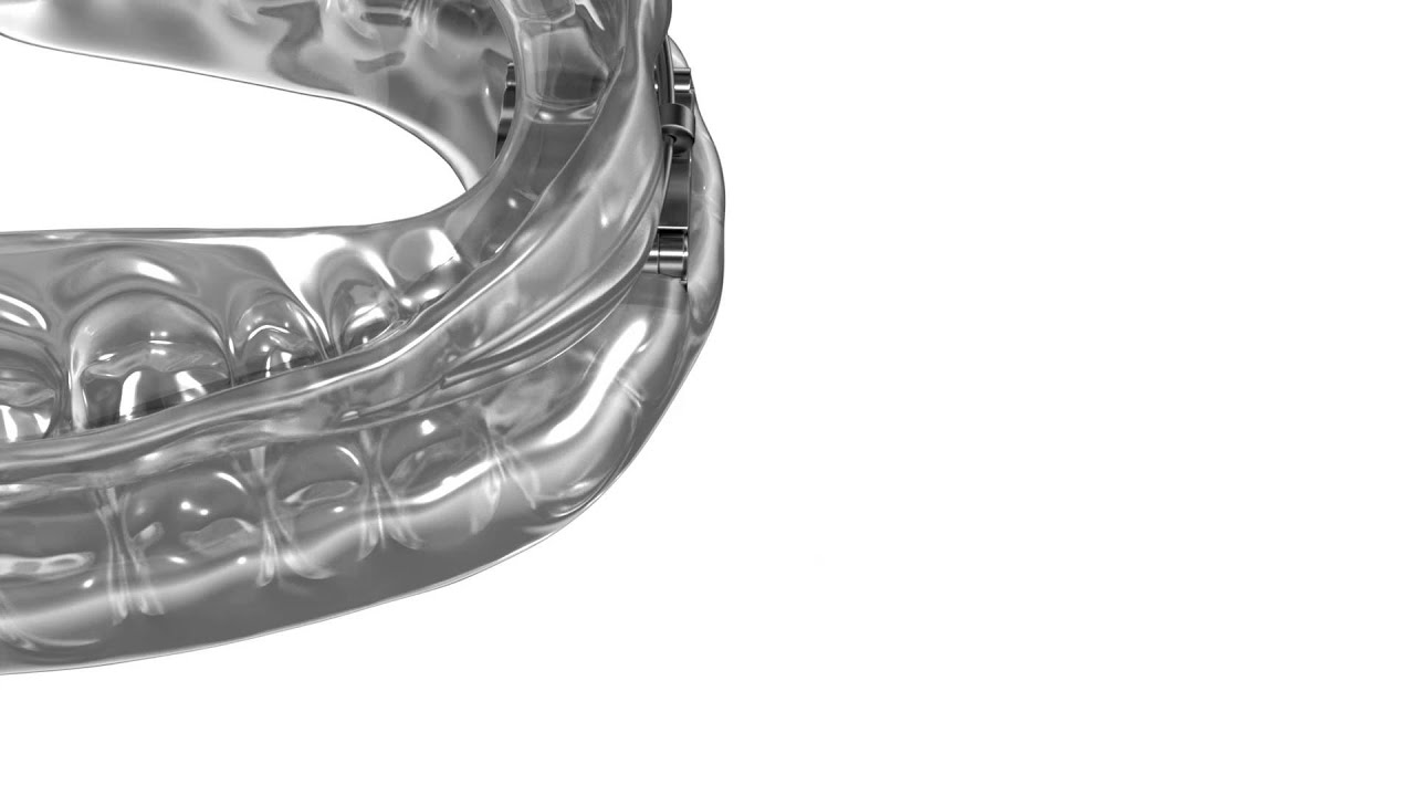 dreamTAP Sleep Apnea Device YouTube