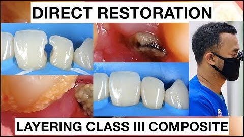 Step by step Layering Composite Class III Anterior | General Dentist Griya RR