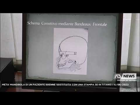 META' MANDIBOLA DI UN PAZIENTE 50ENNE 'SOSTITUITA' CON UNA STAMPA 3D IN TITANIO | 14/08/2023